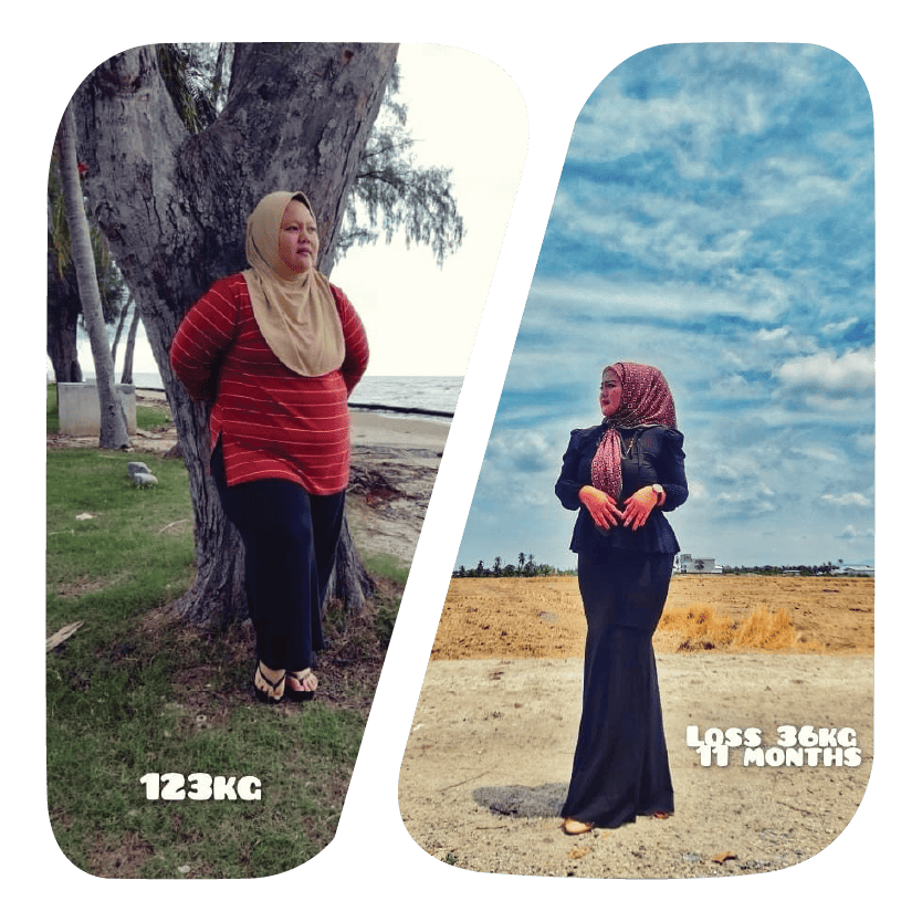 Weight Loss Surgery