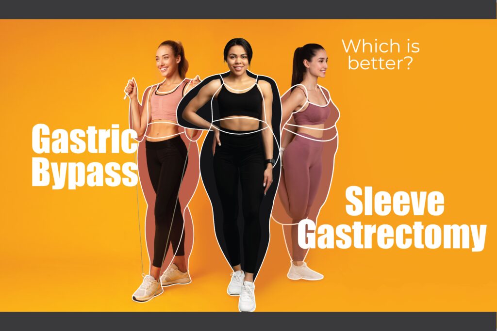 Sleeve Gastrectomy vs. Gastric Bypass: Which Is Better for Obesity in Malaysia?
