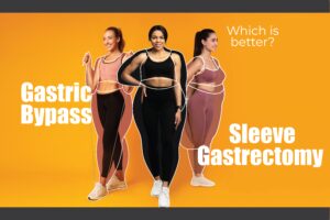 Sleeve Gastrectomy vs. Gastric Bypass: Which Is Better for Obesity in Malaysia?