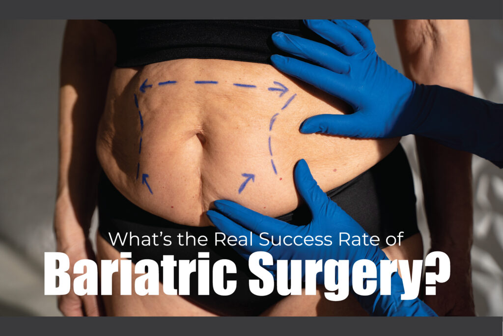 What’s the Real Success Rate of Bariatric Surgery?