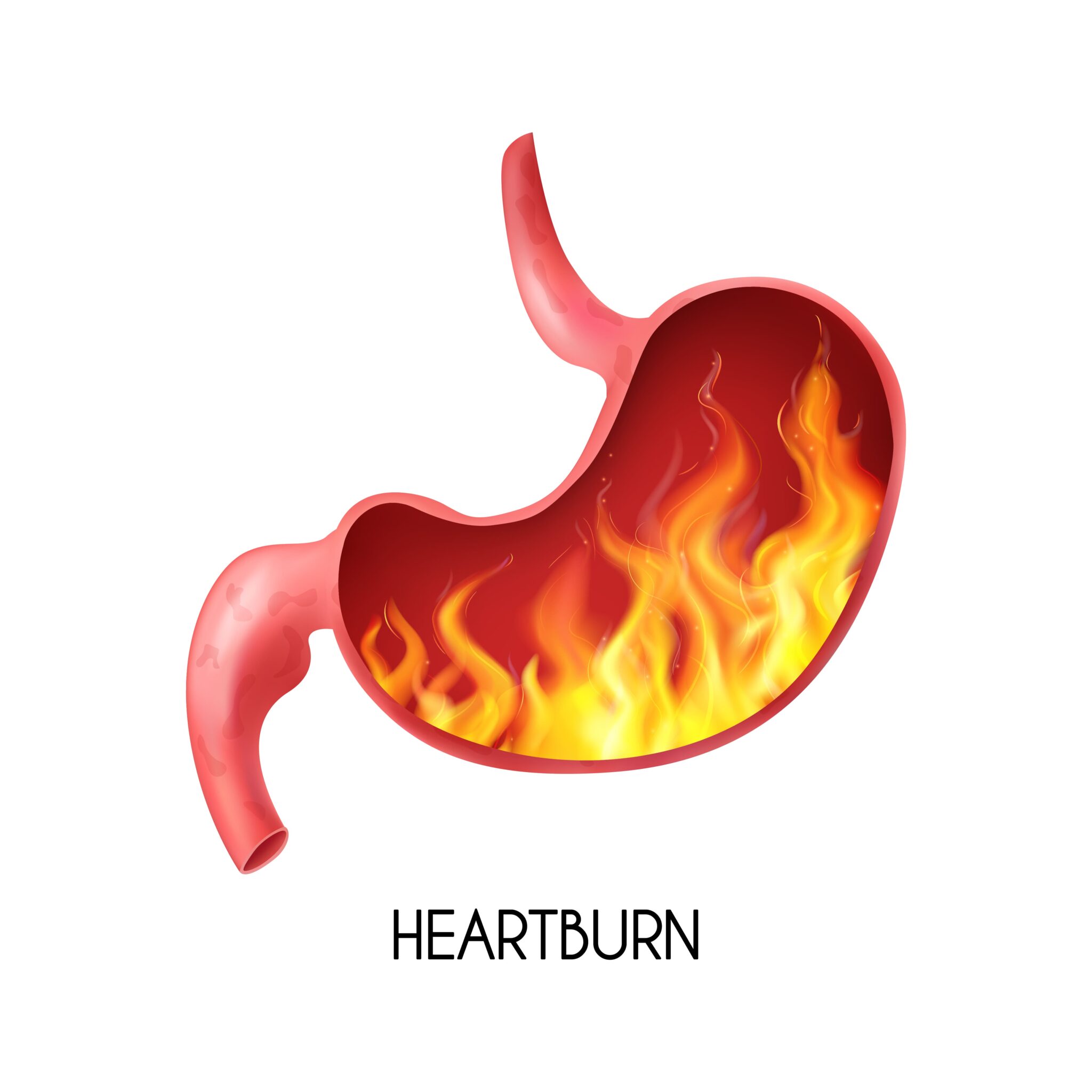 Why Do I Get Heartburn Every Day? gerd