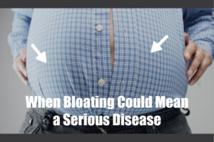When Bloating Could Mean a Serious Disease