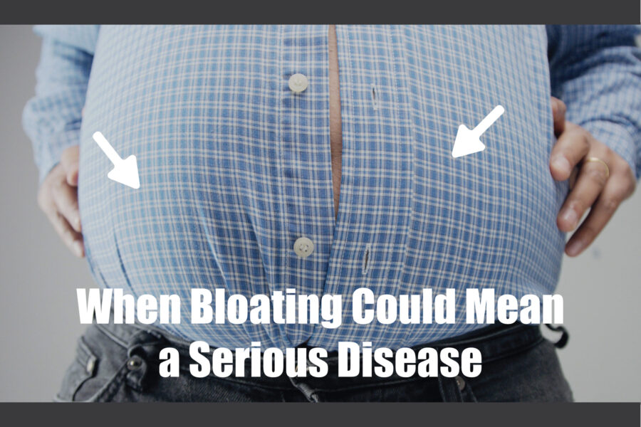 When Bloating Could Mean a Serious Disease