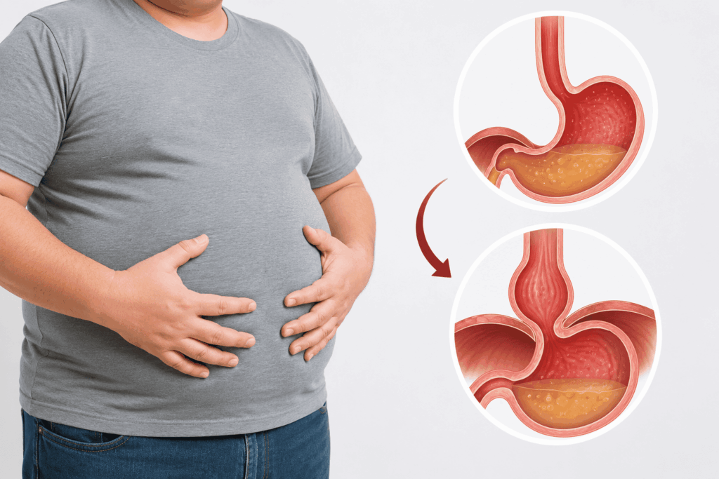 Does Obesity Cause Hiatal Hernia?